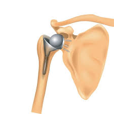 Course of arthroscopic surgery of the shoulder